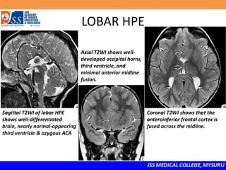 LOBAR HPE
Sagittal T2WI of lobar HPE
shows well-differentiated
brain, nearly normal-appearing
third ventricle & azygous ACA
Axial T2WI shows well-
developed occipital horns,
third ventricle, and
minimal anterior midline
fusion.
Coronal T2WI shows that the
anteroinferior frontal cortex is
fused across the midline.
 