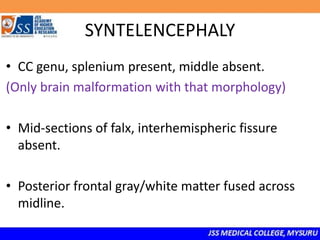 SYNTELENCEPHALY
• CC genu, splenium present, middle absent.
(Only brain malformation with that morphology)
• Mid-sections of falx, interhemispheric fissure
absent.
• Posterior frontal gray/white matter fused across
midline.
 