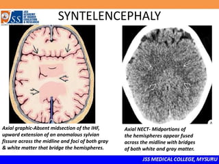 SYNTELENCEPHALY
Axial graphic-Absent midsection of the IHF,
upward extension of an anomalous sylvian
fissure across the midline and foci of both gray
& white matter that bridge the hemispheres.
Axial NECT- Midportions of
the hemispheres appear fused
across the midline with bridges
of both white and gray matter.
 
