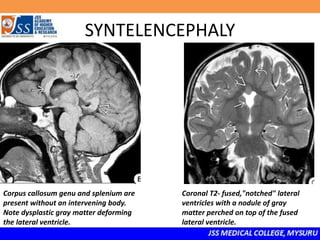 SYNTELENCEPHALY
Corpus callosum genu and splenium are
present without an intervening body.
Note dysplastic gray matter deforming
the lateral ventricle.
Coronal T2- fused,"notched" lateral
ventricles with a nodule of gray
matter perched on top of the fused
lateral ventricle.
 