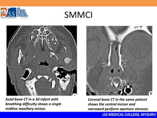 SMMCI
Axial bone CT in a 3d infant with
breathing difficulty shows a single
midline maxillary incisor.
Coronal bone CT in the same patient
shows the central incisor and
narrowed pyriform aperture stenosis.
 