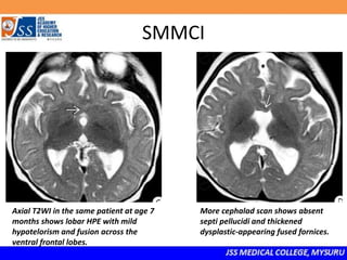 SMMCI
Axial T2WI in the same patient at age 7
months shows lobar HPE with mild
hypotelorism and fusion across the
ventral frontal lobes.
More cephalad scan shows absent
septi pellucidi and thickened
dysplastic-appearing fused fornices.
 