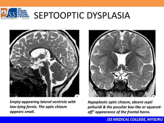 SEPTOOPTIC DYSPLASIA
Empty-appearing lateral ventricle with
low-lying fornix. The optic chiasm
appears small.
Hypoplastic optic chiasm, absent septi
pellucidi & the peculiar box-like or squared-
off" appearance of the frontal horns.
 