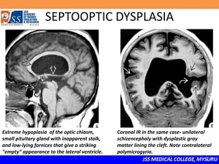 SEPTOOPTIC DYSPLASIA
Extreme hypoplasia of the optic chiasm,
small pituitary gland with inapparent stalk,
and low-lying fornices that give a striking
"empty“ appearance to the lateral ventricle.
Coronal IR in the same case- unilateral
schizencephaly with dysplastic gray
matter lining the cleft. Note contralateral
polymicrogyria.
 