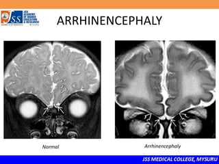 ARRHINENCEPHALY
Normal Arrhinencephaly
 