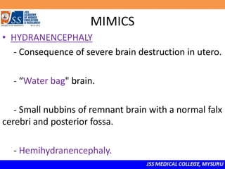 MIMICS
• HYDRANENCEPHALY
- Consequence of severe brain destruction in utero.
- “Water bag" brain.
- Small nubbins of remnant brain with a normal falx
cerebri and posterior fossa.
- Hemihydranencephaly.
 