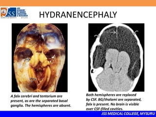 HYDRANENCEPHALY
A falx cerebri and tentorium are
present, as are the separated basal
ganglia. The hemispheres are absent.
Both hemispheres are replaced
by CSF. BG/thalami are separated,
falx is present. No brain is visible
over CSF-filled cavities.
 