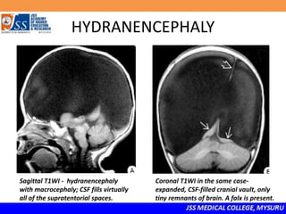 HYDRANENCEPHALY
Sagittal T1WI - hydranencephaly
with macrocephaly; CSF fills virtually
all of the supratentorial spaces.
Coronal T1WI in the same case-
expanded, CSF-filled cranial vault, only
tiny remnants of brain. A falx is present.
 