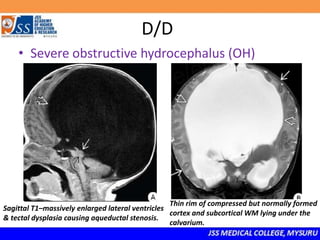 D/D
• Severe obstructive hydrocephalus (OH)
Sagittal T1–massively enlarged lateral ventricles
& tectal dysplasia causing aqueductal stenosis.
Thin rim of compressed but normally formed
cortex and subcortical WM lying under the
calvarium.
 