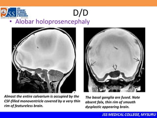 D/D
• Alobar holoprosencephaly
Almost the entire calvarium is occupied by the
CSF-filled monoventricle covered by a very thin
rim of featureless brain.
The basal ganglia are fused. Note
absent falx, thin rim of smooth
dysplastic appearing brain.
 