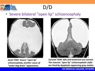 D/D
• Severe bilateral "open lip" schizencephaly
Axial T2WI- Severe "open lip"
schizencephaly, another cause of
"water-bag brain" appearance.
Coronal T2WI- falx and tentorium are normal.
The massive "open lip" schizencephalic clefts
are lined by dysplastic-appearing gray matter.
 