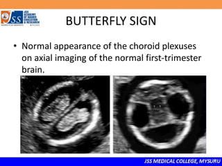 BUTTERFLY SIGN
• Normal appearance of the choroid plexuses
on axial imaging of the normal first-trimester
brain.
 
