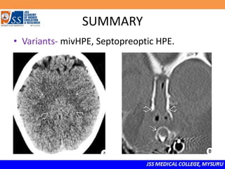 SUMMARY
• Variants- mivHPE, Septopreoptic HPE.
 