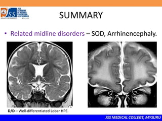 SUMMARY
• Related midline disorders – SOD, Arrhinencephaly.
D/D – Well-differentiated Lobar HPE.
 