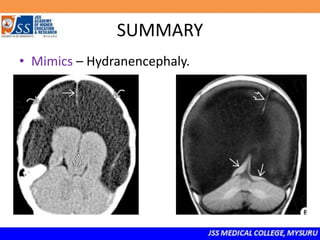 SUMMARY
• Mimics – Hydranencephaly.
 