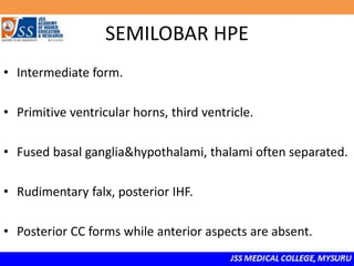 SEMILOBAR HPE
• Intermediate form.
• Primitive ventricular horns, third ventricle.
• Fused basal ganglia&hypothalami, thalami often separated.
• Rudimentary falx, posterior IHF.
• Posterior CC forms while anterior aspects are absent.
 