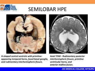 SEMILOBAR HPE
H-shaped central ventricle with primitive-
appearing temporal horns, fused basal ganglia,
and rudimentary interhemispheric fissure.
Axial T2WI - Rudimentary posterior
interhemispheric fissure, primitive
ventricular horns, and
anterior midline fusion.
 