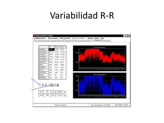 Variabilidad R-R
 