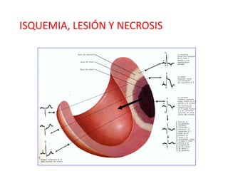 ISQUEMIA, LESIÓN Y NECROSIS
 