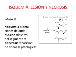 ISQUEMIA, LESIÓN Y NECROSIS

Infarto Q

•Isquemia :altera-
ciones de onda T
•Lesión :desnivel
del segmento st
•Necrosis :aparición
de ondas Q patológicas
 