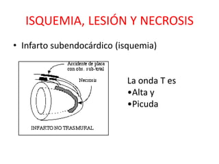 ISQUEMIA, LESIÓN Y NECROSIS
• Infarto subendocárdico (isquemia)


                           La onda T es
                           •Alta y
                           •Picuda
 