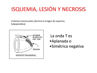 ISQUEMIA, LESIÓN Y NECROSIS
•Infartos transmurales (domina la imagen de isquemia
Subepicárdica)




                                     La onda T es
                                     •Aplanada o
                                     •Simétrica negativa
 