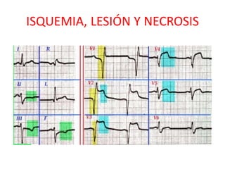 ISQUEMIA, LESIÓN Y NECROSIS
 
