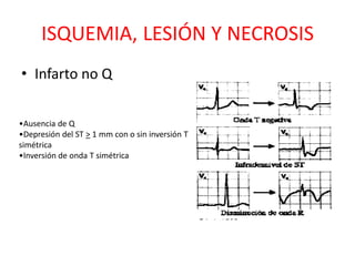 ISQUEMIA, LESIÓN Y NECROSIS
• Infarto no Q


•Ausencia de Q
•Depresión del ST > 1 mm con o sin inversión T
simétrica
•Inversión de onda T simétrica
 