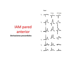IAM pared
      anterior
Derivaciones precordiales
 
