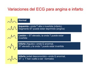 Variaciones del ECG para angina e infarto

     Normal

     Isquemia—onda T alta o invertida (infarto),
     Segmento ST puede estar deprimido (angina)

     Lesión— ST elevado, la onda T puede estar
     invertida

     Infarto (Agudo)—onda Q anormal,
     ST elevado y la onda T puede estar invertida



     Infarto (edad desconocida)—onda Q anormal,
     ST y T han vuelto a ser normales
 