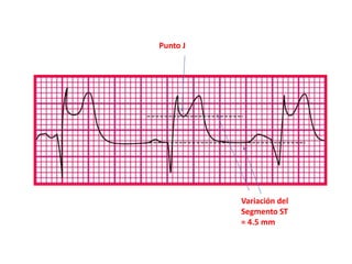 Punto J




          Variación del
          Segmento ST
          = 4.5 mm
 