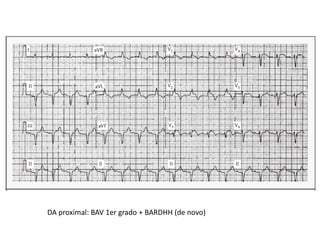 DA proximal: BAV 1er grado + BARDHH (de novo)
 