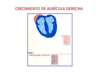 CRECIMIENTO DE AURÍCULA DERECHA
 