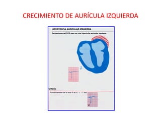 CRECIMIENTO DE AURÍCULA IZQUIERDA
 
