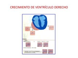 CRECIMIENTO DE VENTRÍCULO DERECHO
 