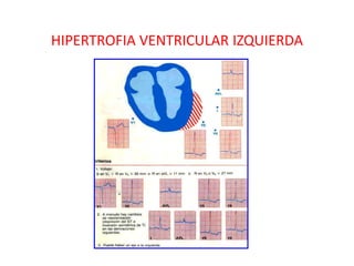 HIPERTROFIA VENTRICULAR IZQUIERDA
 