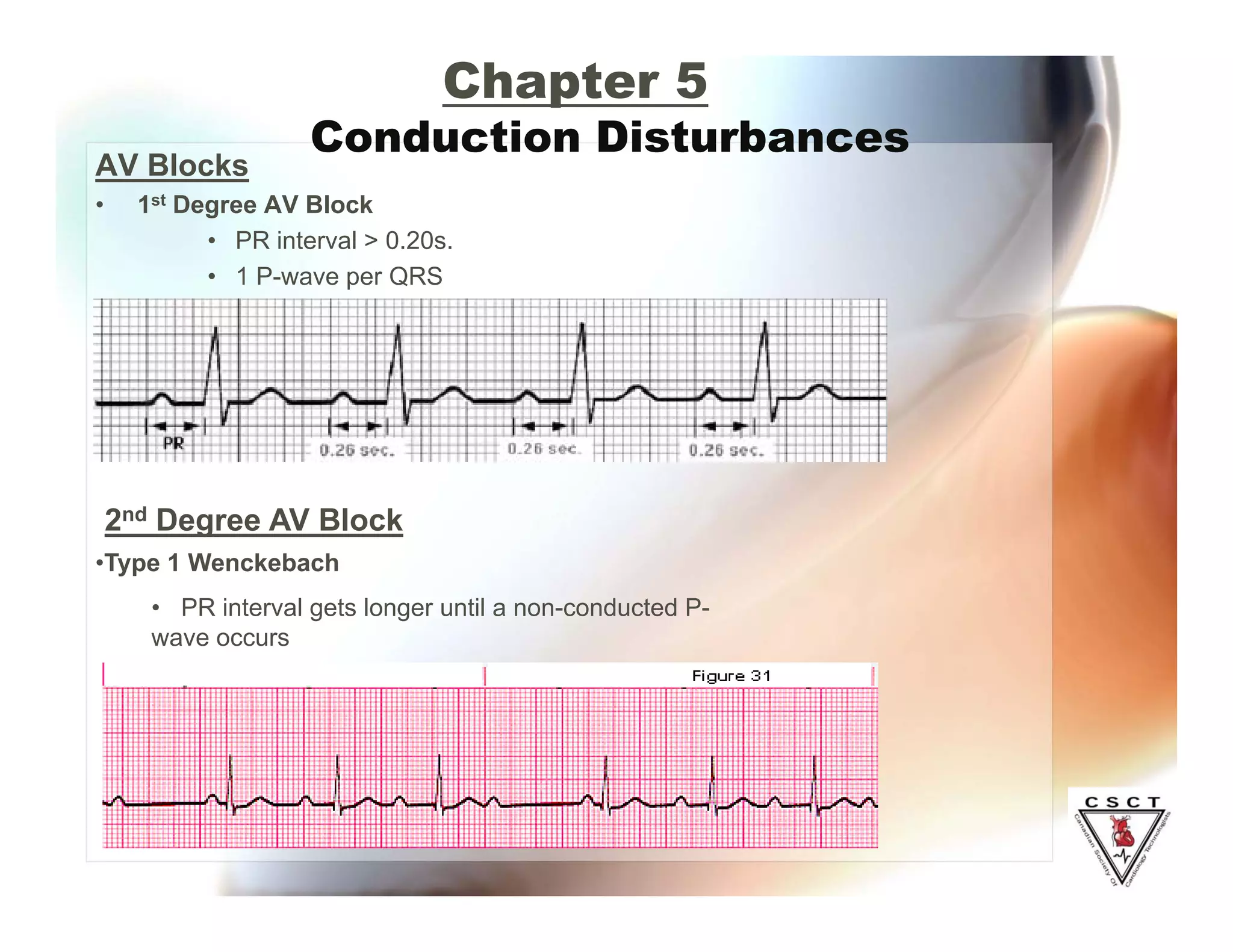 Holter monitor1 | PDF