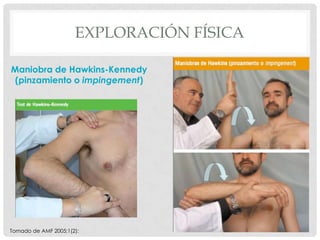 EXPLORACIÓN FÍSICA

Maniobra de Hawkins-Kennedy
 (pinzamiento o impingement)




Tomado de AMF 2005;1(2):             J. Javier Blanquer 2011   17
 