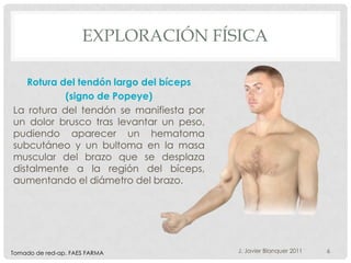 EXPLORACIÓN FÍSICA

   Rotura del tendón largo del bíceps
           (signo de Popeye)
La rotura del tendón se manifiesta por
un dolor brusco tras levantar un peso,
pudiendo aparecer un hematoma
subcutáneo y un bultoma en la masa
muscular del brazo que se desplaza
distalmente a la región del bíceps,
aumentando el diámetro del brazo.




Tomado de red-ap. FAES FARMA             J. Javier Blanquer 2011   6
 