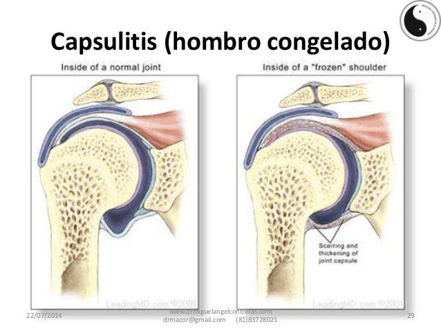 CAPSULITIS DE HOMBRO DOWNLOAD CAPSULITIS DE HOMBRO DOWNLOAD