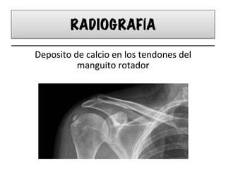 RADIOGRAFÍA
Deposito	
  de	
  calcio	
  en	
  los	
  tendones	
  del	
  
manguito	
  rotador	
  
 