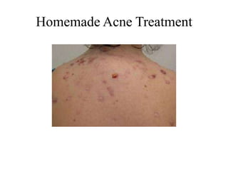 Homemade Acne Treatment
 