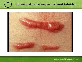 www.medisyskart.com
Homeopathic remedies to treat keloids
 