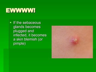 EWWWW! If the sebaceous glands becomes plugged and infected, it becomes a skin blemish (or pimple) 