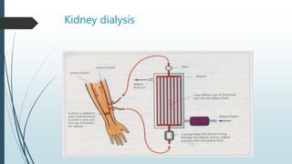 Kidney dialysis
 