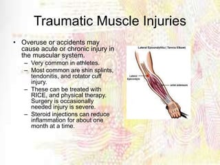 Traumatic Muscle Injuries
• Overuse or accidents may
cause acute or chronic injury in
the muscular system.
– Very common in athletes.
– Most common are shin splints,
tendonitis, and rotator cuff
injury.
– These can be treated with
RICE, and physical therapy.
Surgery is occasionally
needed injury is severe.
– Steroid injections can reduce
inflammation for about one
month at a time.
 