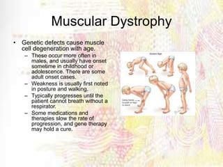 Muscular Dystrophy
• Genetic defects cause muscle
cell degeneration with age.
– These occur more often in
males, and usually have onset
sometime in childhood or
adolescence. There are some
adult onset cases.
– Weakness is usually first noted
in posture and walking.
– Typically progresses until the
patient cannot breath without a
respirator.
– Some medications and
therapies slow the rate of
progression, and gene therapy
may hold a cure.
 