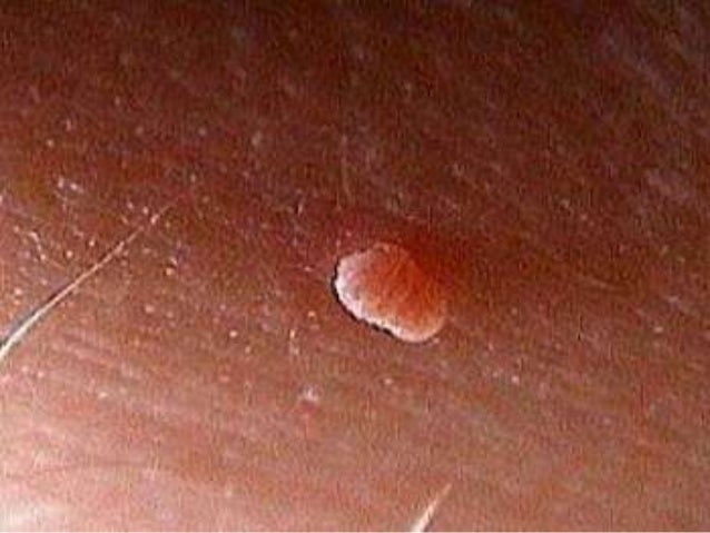 Home Remedies Reviews Removing Moles Skin Tag Removal And