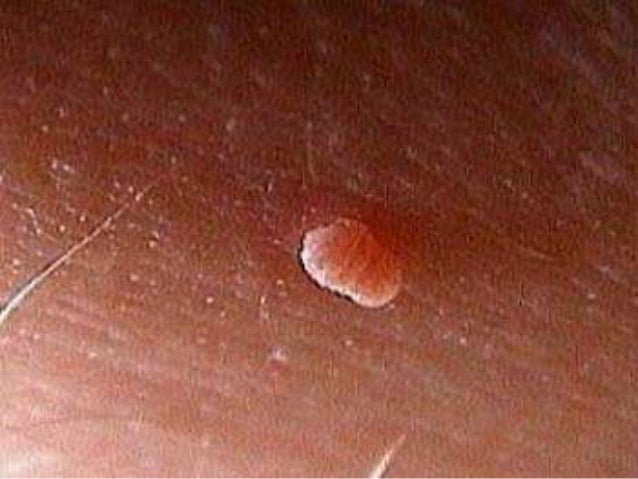 Natural Skin Tag Removal Reviews Natural Skin Tag Removal Reviews