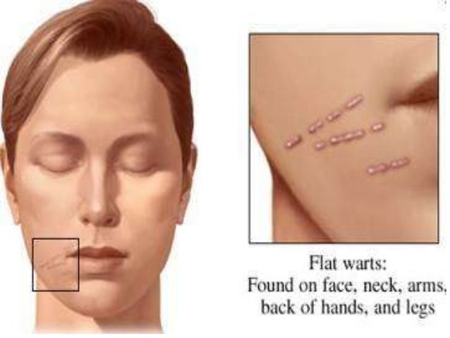 Home Remedies For Wart Scars Home Remedies For Wart Scars